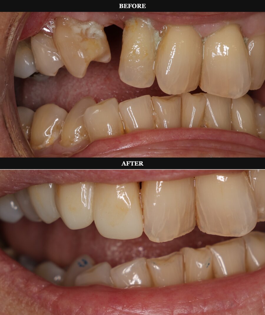 Dental implant before and after results at Swiss Dental Southfield
