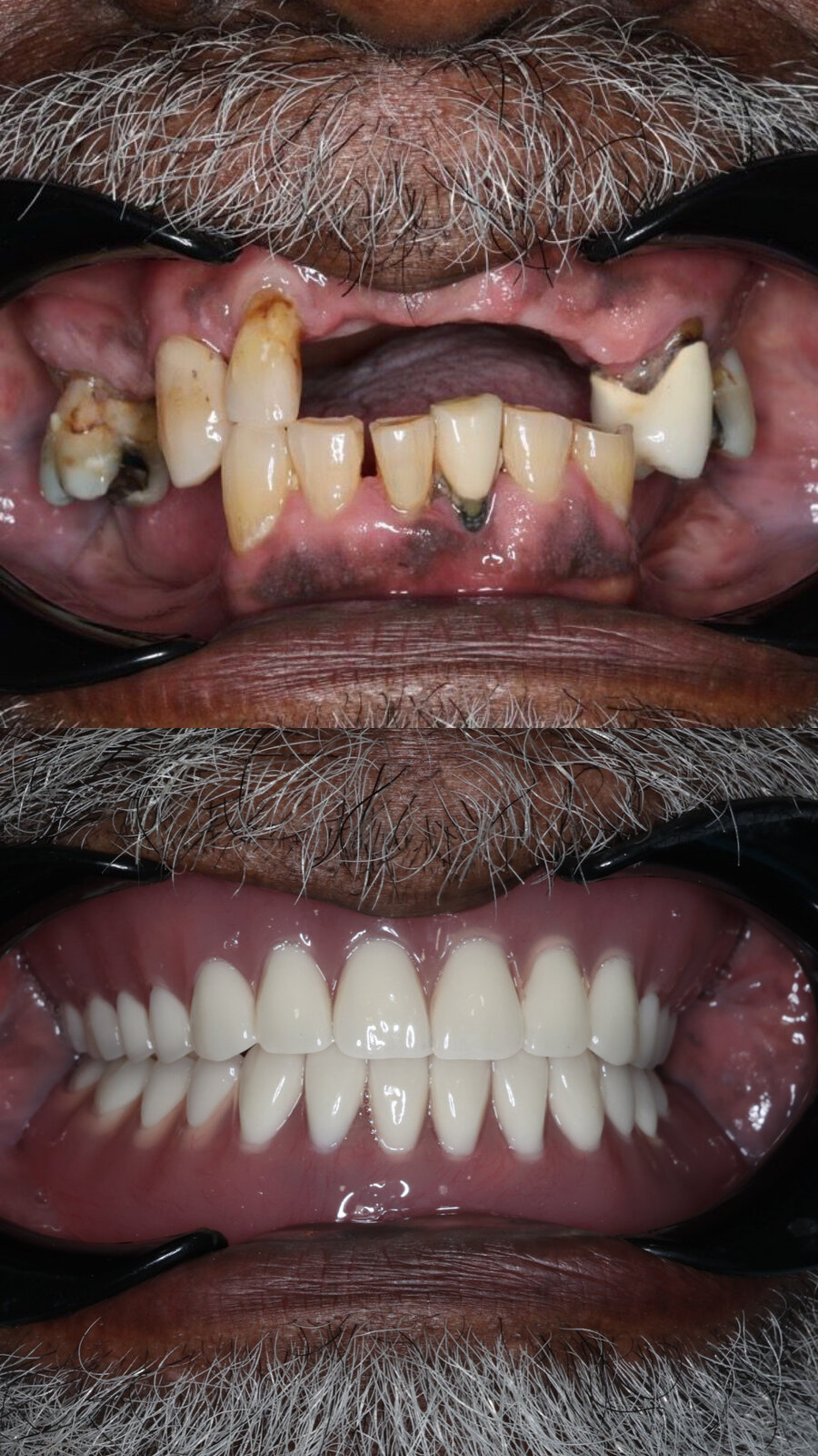 Dental implant before and after results at Swiss Dental Southfield