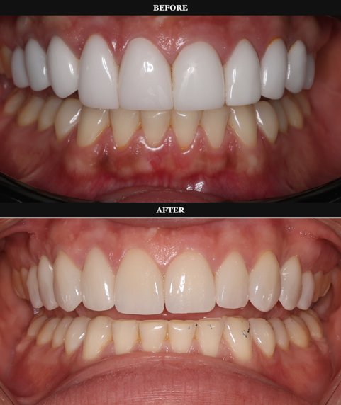 Smile makeover before and after treatment