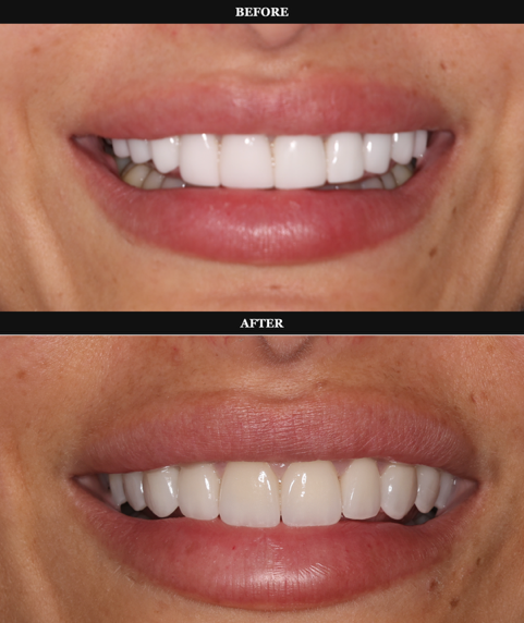 Patient smile before and after treatment